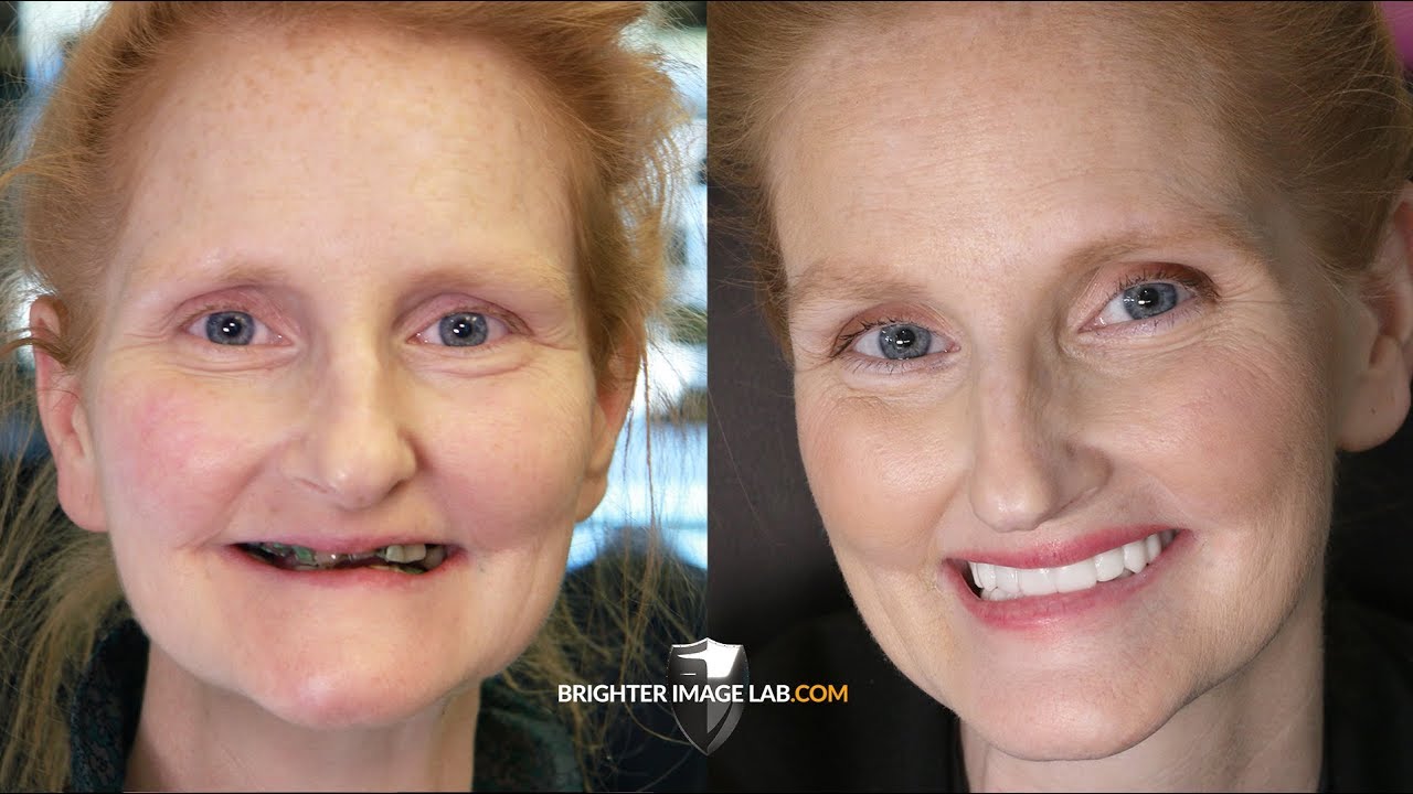 Mother's Day Extreme Smile Makeover – Dental Veneers by Brighter Image Lab For Daughter's Wedding Mother's Day Extreme Smile Makeover - Dental Veneers by Brighter Image Lab For Daughter's Wedding