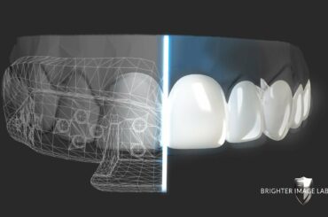 DIY- How to Get Dental Veneers Online with No Dentist!