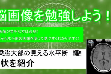 無料で簡単！脳画像の勉強「脳梁膨大部の見える　水平断編　症状紹介」【超簡単解説】