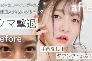 【クマ取り】目の下のクマを取ってみた！ダウンタイム無し！【橋本萌花】