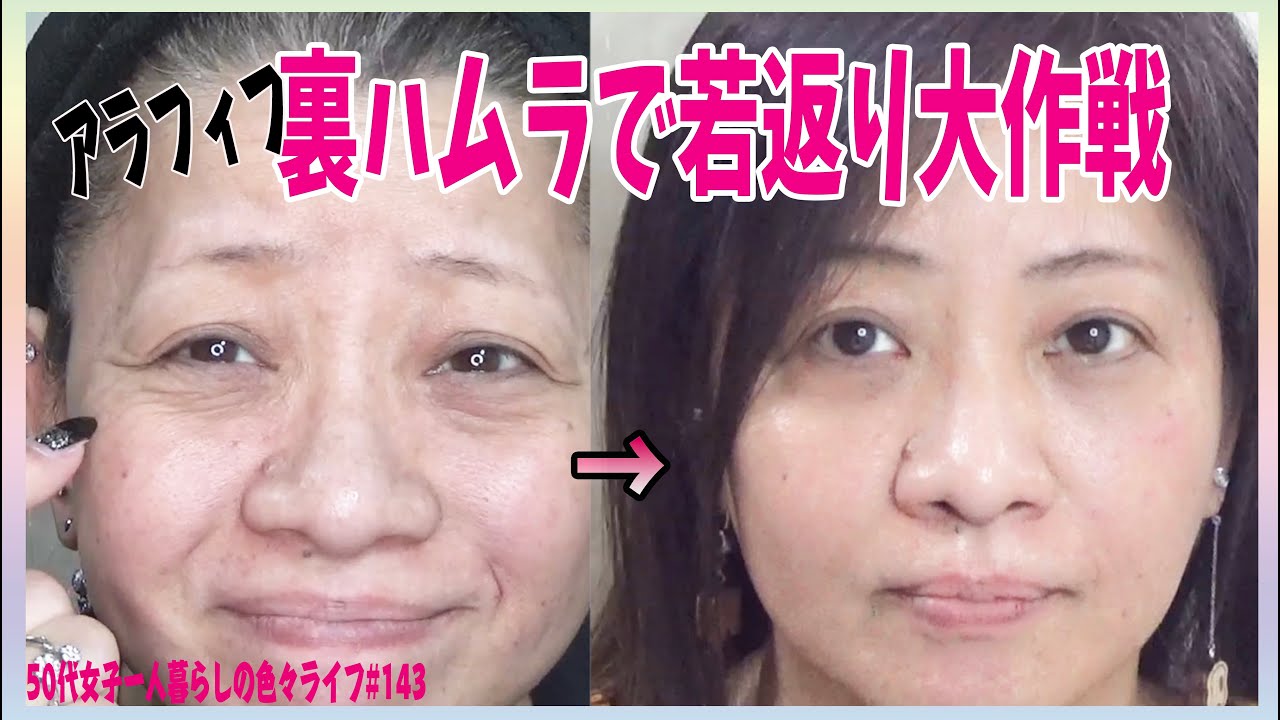 【若返り大作戦】裏ハムラ手術から3ヶ月 完成形と自己評価【アラフィフ】Ver.143 ♥