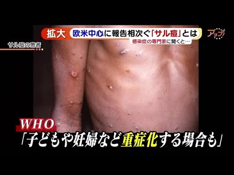 欧米中心に拡大する「サル痘」 感染症の専門家「コロナのようにどんどん広まってしまうことはないと思う」 (22/05/27 15:07)