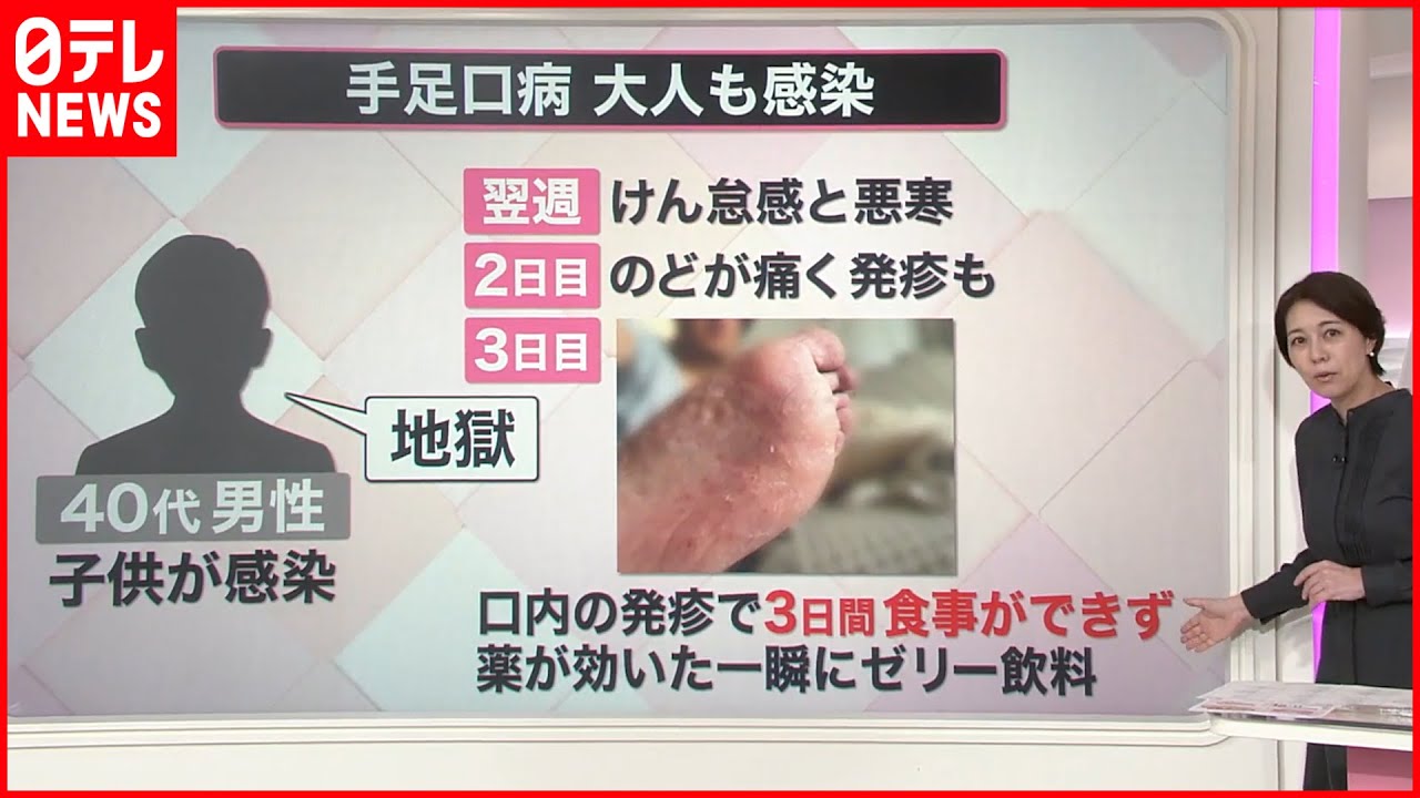 【解説】大人も注意…手足口病  「ガラスが刺さったみたい」「地獄」  9月入っても“警報級”流行