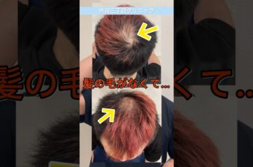 【ハゲ防止】ミノキシジルを飲み続けた結果...