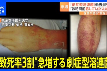 “致死率3割”急増する劇症型溶連菌 「数時間前まで話していた患者が…」救急医が進行の速さ語る　今年の患者数977人で既に去年1年間を上回る｜TBS NEWS DIG