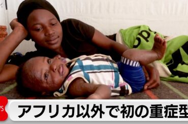 スウェーデン　より重症化しやすいタイプのエムポックス感染者