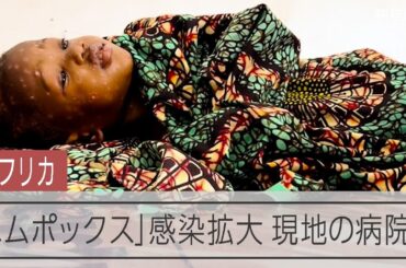 「エムポックス」がコンゴ民主共和国で感染拡大、現地の病院は…