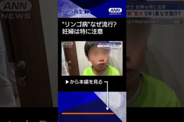 【ニュース】【“リンゴ病”拡大】5年1度なぜ流行？症状は？　妊婦は特に注意#shorts