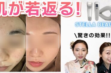 【ニキビが消えた！】脱毛して美肌に！ステラボーテ脱毛器