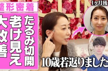 【マイナス10歳！？】老け見えを改善できるA式美肌たるみ切開で劇的な若返り！