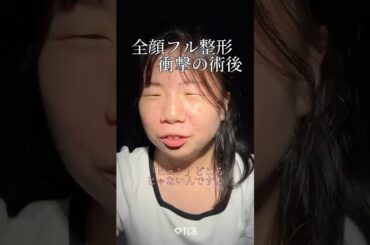 【二重整形】全顔フル整形 衝撃の術後 #shorts