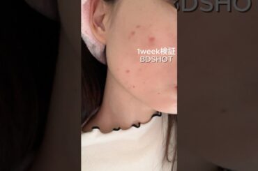 BDSHOT1week検証！ここまで綺麗になったよ👍 #美容液 #スキンケア #毛穴 #ニードルショット #リードルショット #BDショット #垢抜け #韓国コスメ #pr
