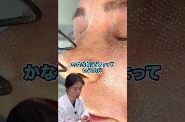 フラクショナルCO2レーザーはアメリカ皮膚科学会でも推奨されています！