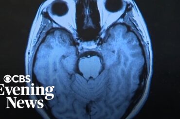 Researcher says Long COVID causing "great deal of suffering"