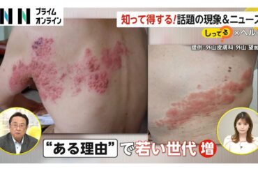 【注意】ストレスや疲労などで発症「帯状疱疹」子ども“水ぼうそう”ワクチン接種で大人の免疫力低下？20～40代も増加傾向に