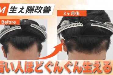 毛根再生注射が凄すぎた！生え際改善ビフォーアフター公開
