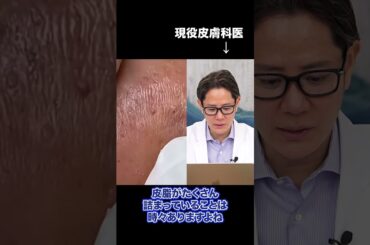 毛穴の角栓をニュルって取る動画#shorts