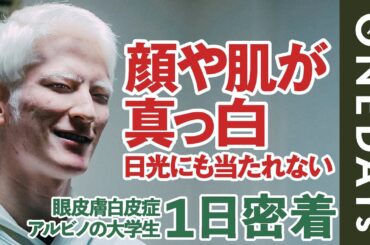 【生まれつき真っ白】アルビノの男性に1日密着してみた