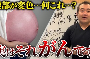 放置すると超危険！あまり知られていない卵巣がんと腹水の関係を産婦人科医が解説！