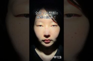 【二重整形】全顔フル整形で衝撃の結末！#shorts