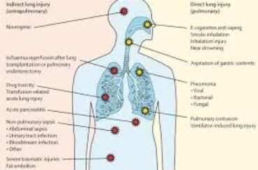 リスク評価の例 重篤な呼吸器疾患の場合