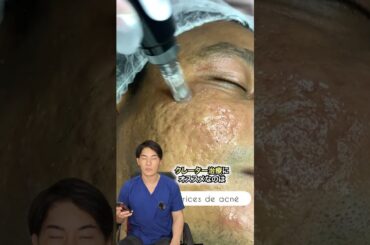 ニキビ跡のクレーターを綺麗に治す方法 #shorts
