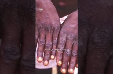 إعلان حالة طوارئ صحية دولياً