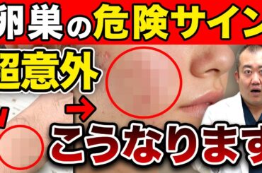 【放置厳禁】知らないと後悔する卵巣のSOS！多嚢胞性卵巣(PCOS)について産婦人科医が解説！