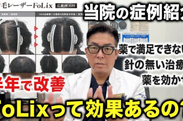 【新治療】発毛レーザーFoLixの効果について私の見解を話します【AGA薬を効かせる】