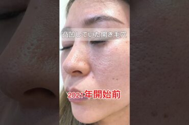 凸凹していた開き毛穴。自分の肌を見る度にみかんの皮🍊みたいだと思っていた私。正しい毛穴ケアの継続でここまで変われるから、毛穴は変わらないなんて諦めないで❣️#毛穴ケア #開き毛穴 #凸凹毛穴 #毛穴