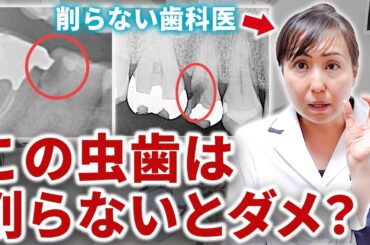 どの程度の虫歯なら削らなくても治せるの？"削らない治療"ドックベストセメントを専門家が簡単解説！
