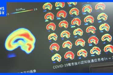 「ブレインフォグ」解消の糸口掴む コロナ後遺症患者の脳を分析「アンパ受容体」の密度が健常者より高いと判明 横浜市立大学病院の研究結果「治療法開発につながる成果」｜TBS NEWS DIG