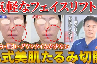気軽に受けられるフェイスリフト?たるみを引き上げる”A式美肌たるみ切開”について解説 気軽に受けられるフェイスリフト?たるみを引き上げる"A式美肌たるみ切開"について解説