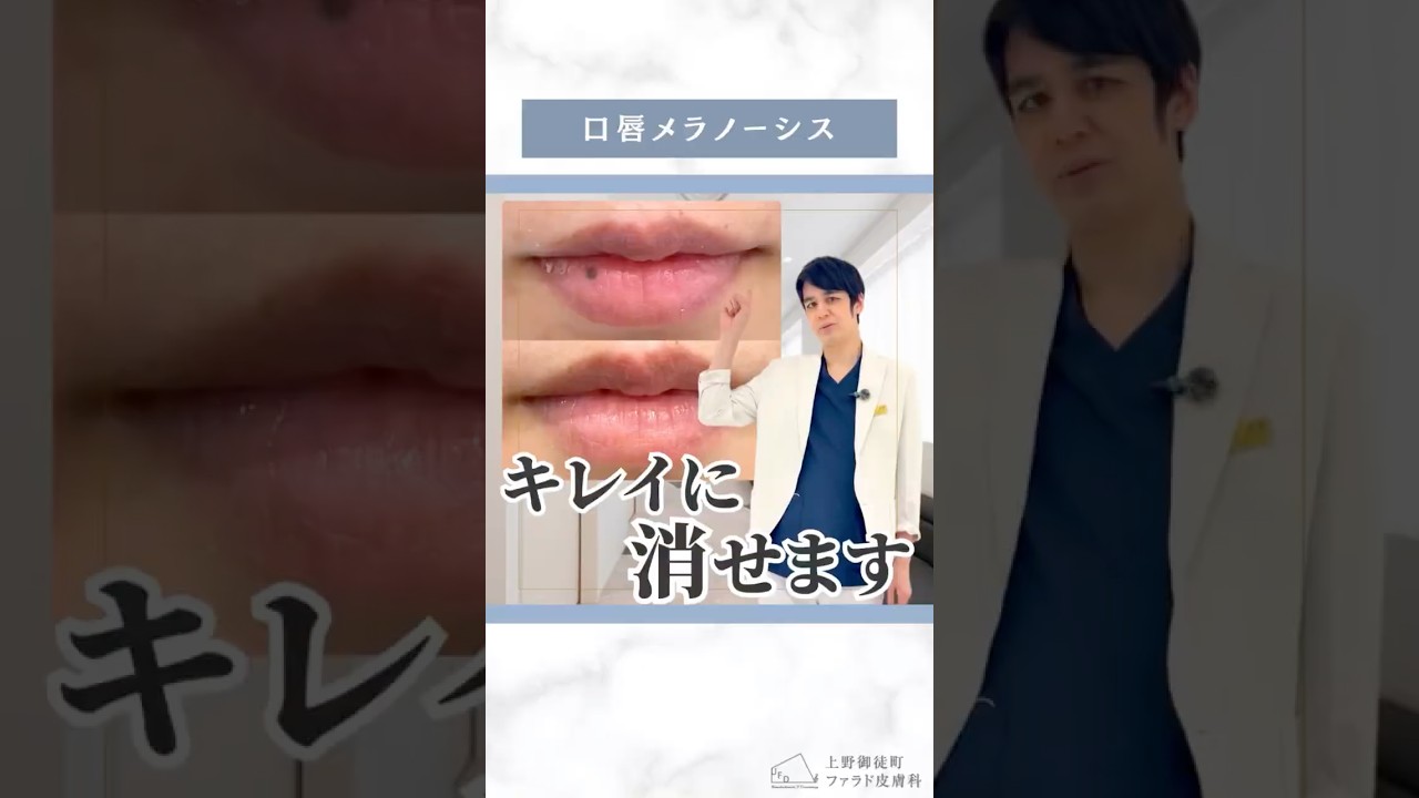 【くちびるのシミ　口唇メラノーシス】 #ファラド皮膚科 #美容皮膚科 #美肌 #皮膚科専門医 #肌質改善 #シミ #ピコレーザー #qスイッチルビーレーザー