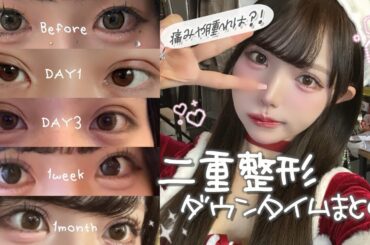 【二重整形】2回目の埋没!!腫れやダウンタイムの様子を正直に話してます🍀*゜