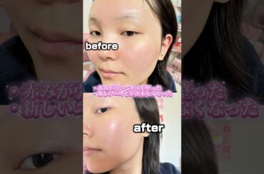 肌荒れ悩んでる人はとりあえずやって！#shorts #スキンケア #肌荒れ #肌荒れ改善 #ニキビ #ニキビ肌 #ニキビ改善 #美肌 #垢抜け #おすすめ #fyp