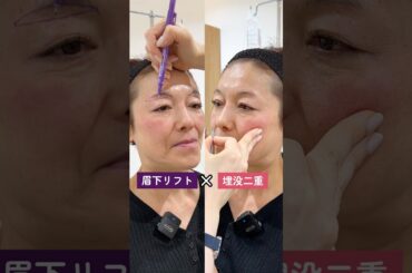 【眉下切開と埋没は同時にやってもいいの🧐❔】 #美容整形 #二重整形 #眉下切開
