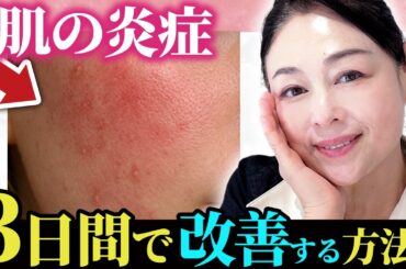 【顔の赤み改善】炎症肌を3日で改善するスキンケア｜すぐ出来る簡単な処置＆おすすめアイテムを解説