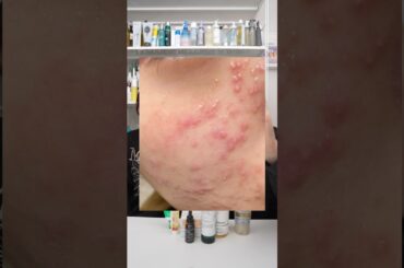 ニキビ肌から美肌になれた理由と使うべきコスメ