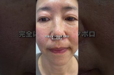 肌が汚くてメンタルズタボロだった私が出会った最強スキンケアはこれだった‼️#自分磨き #美容 #スキンケア #美肌 #針美容液 pr