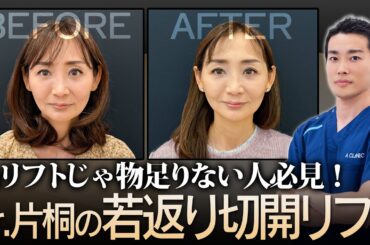 【120%若返り】片桐先生のA式美肌たるみ切開で糸リフト以上にリフトアップした顔に！