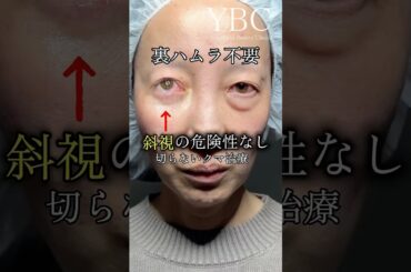 裏ハムラ不要のクマ治療#美容 #クマ取り #目の下のクマ #若返り #イソセン#ybc横浜美容外科