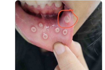 【画像】女の子、実の兄とキスをして口内炎をうつされるｗｗｗｗｗｗｗｗｗ