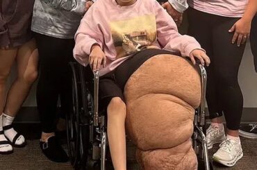 【画像】14歳のアメリカ人少女、手術で約80kgの減量に成功👱🏻‍♀ｗｗｗｗｗｗｗｗ